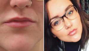 lip-treatment-buckinghamshire