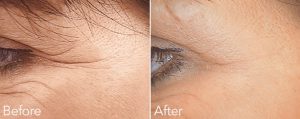 Before and After Wrinkle Treatment UK