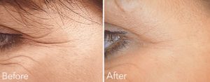 get rid of wrinkles on your face