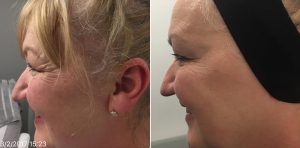 Before and After Wrinkle Treatment UK