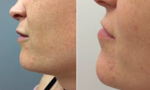 lip treatment buckinghamshire
