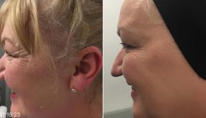 Before and After Wrinkle Treatment UK