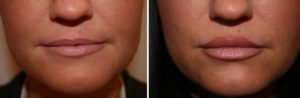 Before and After Treatment