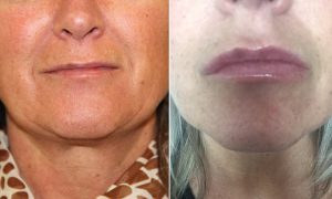 lip treatment buckinghamshire