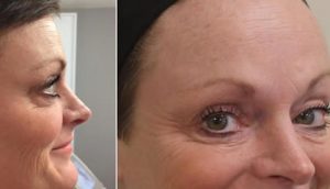 Before and After Wrinkle Treatment UK
