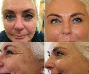 get rid of wrinkles on your face