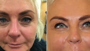 get rid of wrinkles on your face