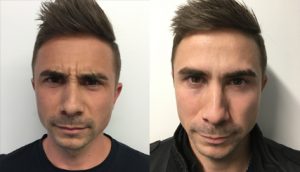 Before and After Wrinkle Treatment UK