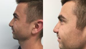 Before and After Wrinkle Treatment UK