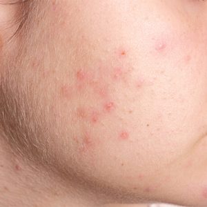 get rid of pimple and acne on face