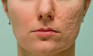 Treating uneven skin with Vampire Facial