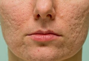acne scars on face