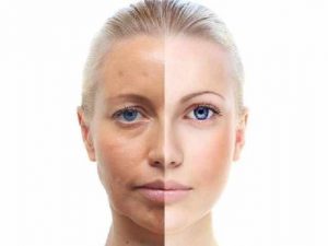 treat-dull-skin